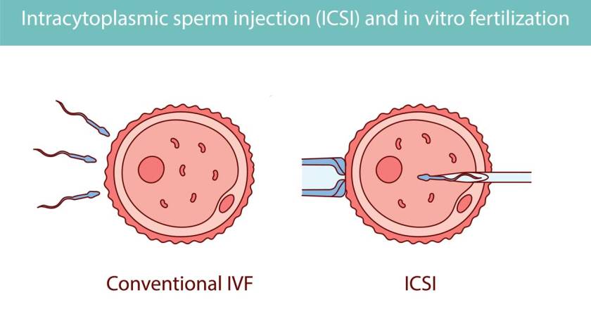 ICSI