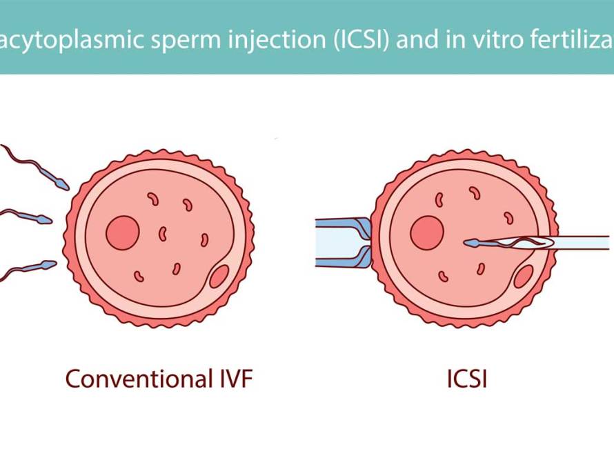 ICSI