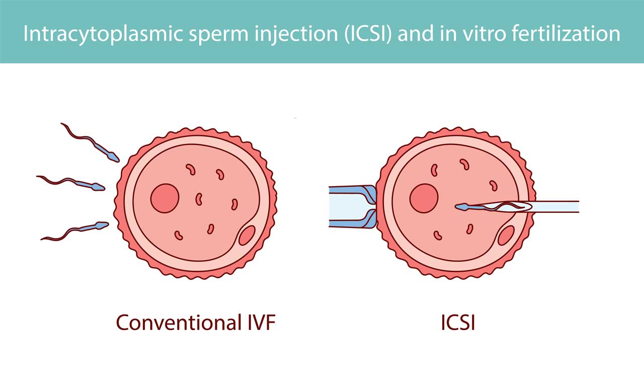 ICSI